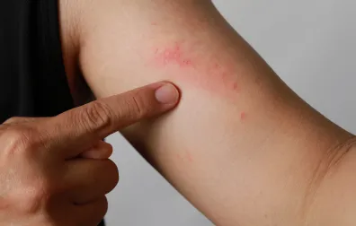 Vinger wijst op eczeem plek