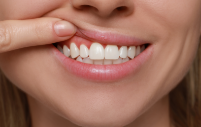 Vrouw laat tandvlees zien