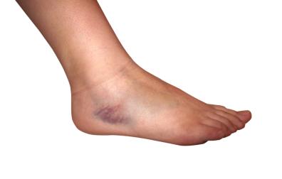 Blauwe plek op enkel