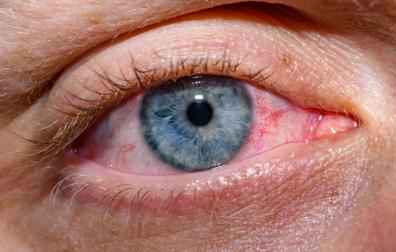 Een oog dat rood is