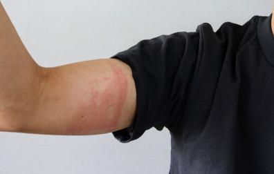 Arm van volwassene met huidschimmelinfectie